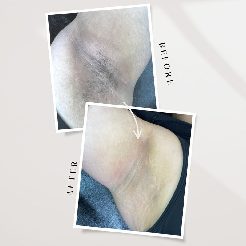 post hair removal, ingrown hair, razor burn, laser hair removal, waxing, shaving irritation